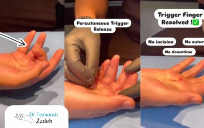 What Is Needle Release for Trigger Finger? A Surgeon Explains the Technique