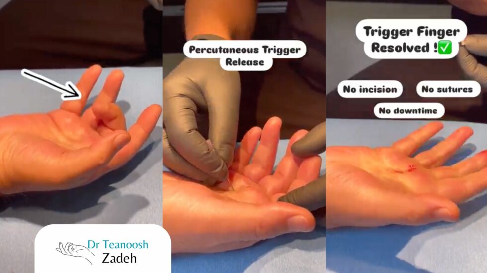 Needle Release for Trigger Finger | Montreal Guide